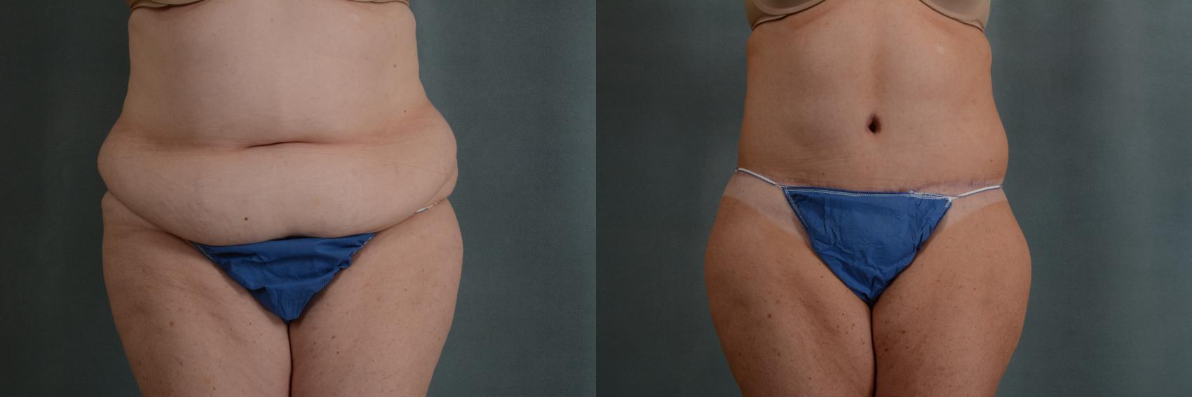 Before & After Extended Tummy Tuck (Abdominoplasty)  Case 313 View #1 View in Tallahassee, FL
