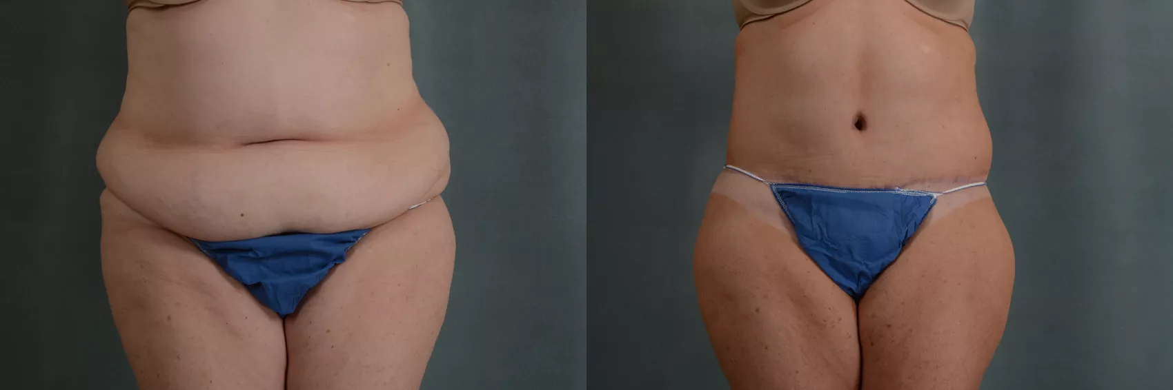 1,823 Abdominoplasty Body Images, Stock Photos, 3D objects