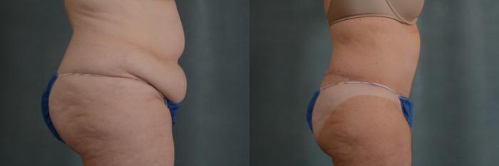Before & After Extended Tummy Tuck (Abdominoplasty)  Case 313 View #2 View in Tallahassee, FL