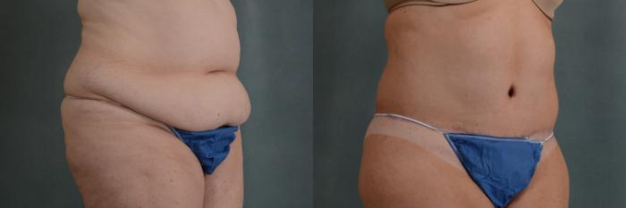 Before & After Extended Tummy Tuck (Abdominoplasty)  Case 313 View #3 View in Tallahassee, FL