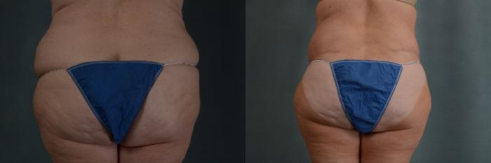 Before & After Extended Tummy Tuck (Abdominoplasty)  Case 313 View #4 View in Tallahassee, FL