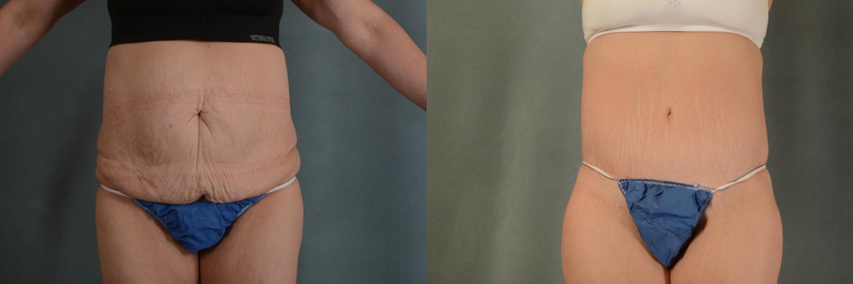 Before & After Extended Tummy Tuck (Abdominoplasty)  Case 407 View #1 View in Tallahassee, FL