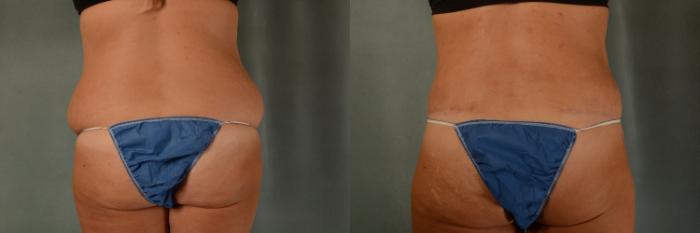 Before & After Extended Tummy Tuck (Abdominoplasty)  Case 444 Back View in Tallahassee, FL