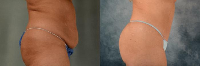 Before & After Extended Tummy Tuck (Abdominoplasty)  Case 532 Right Side View in Tallahassee, FL