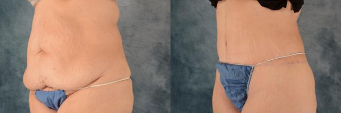 Before & After Extended Tummy Tuck (Abdominoplasty)  Case 573 Left Oblique View in Tallahassee, FL