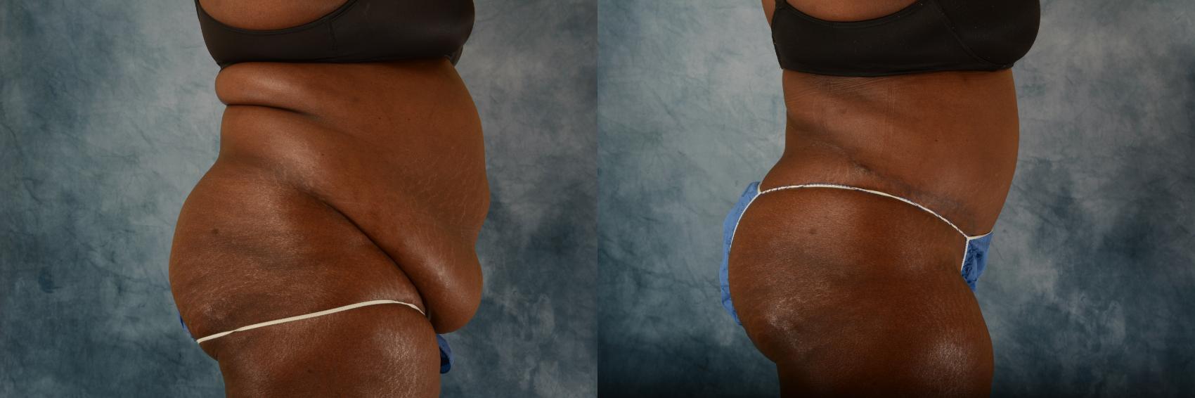 Tummy Tuck