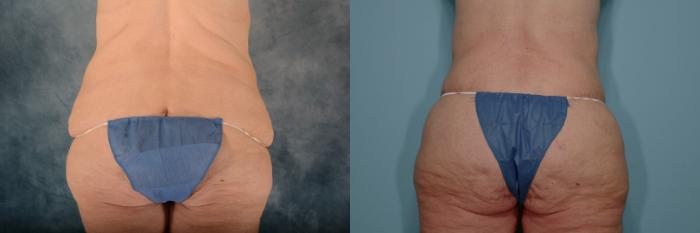Before & After Breast Surgery and Body Contouring Surgery Case 648 Back View in Tallahassee, FL