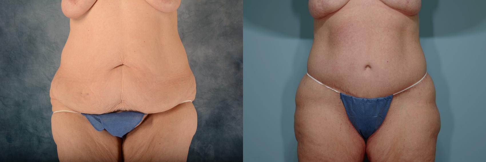 Before & After Breast Surgery and Body Contouring Surgery Case 648 Front View in Tallahassee, FL