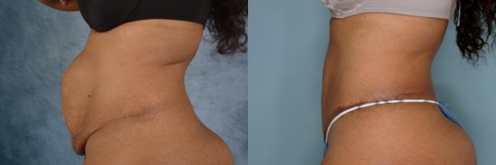 Before & After Extended Tummy Tuck (Abdominoplasty)  Case 658 Left Side View in Tallahassee, FL