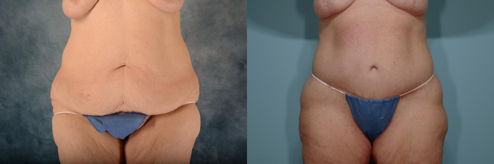 Before & After Extended Tummy Tuck (Abdominoplasty)  Case 687 Front View in Tallahassee, FL