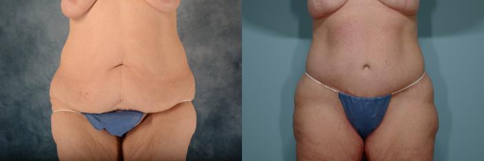 Before & After Extended Tummy Tuck (Abdominoplasty)  Case 687 Front View in Tallahassee, FL