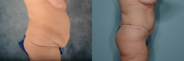 Before & After Extended Tummy Tuck (Abdominoplasty)  Case 687 Right Side View in Tallahassee, FL