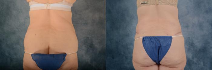 Before & After Extended Tummy Tuck (Abdominoplasty)  Case 694 Back View in Tallahassee, FL
