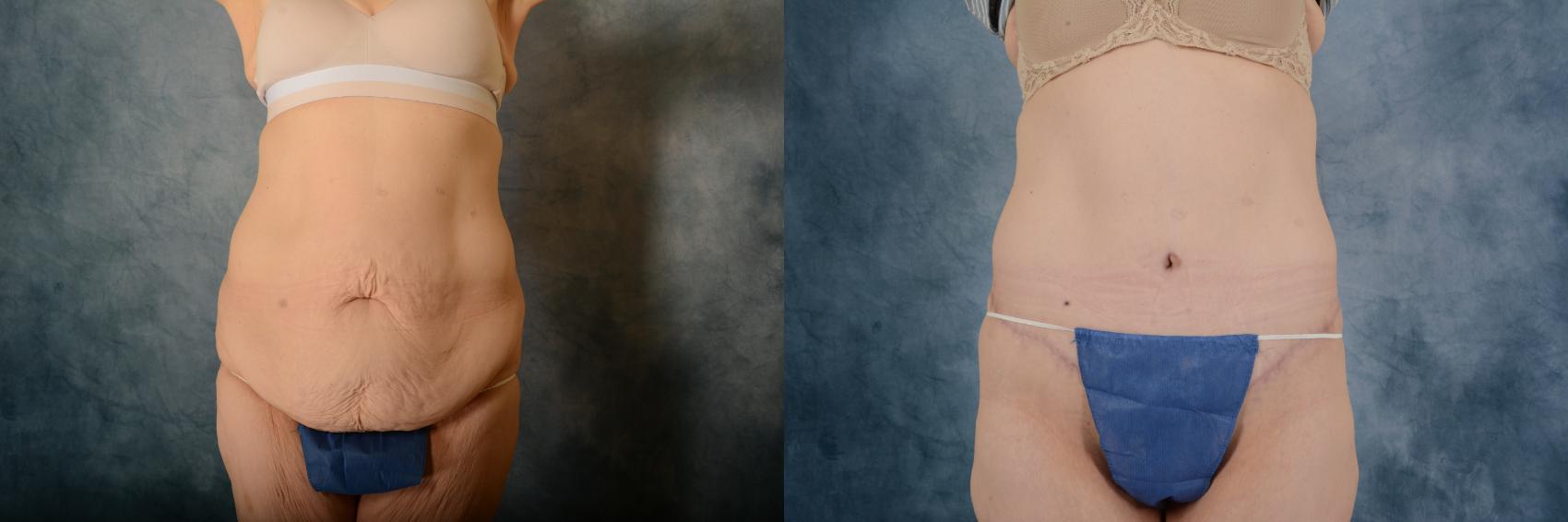 Before & After Extended Tummy Tuck (Abdominoplasty)  Case 694 Front View in Tallahassee, FL