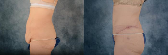 Before & After Extended Tummy Tuck (Abdominoplasty)  Case 694 Left Side View in Tallahassee, FL