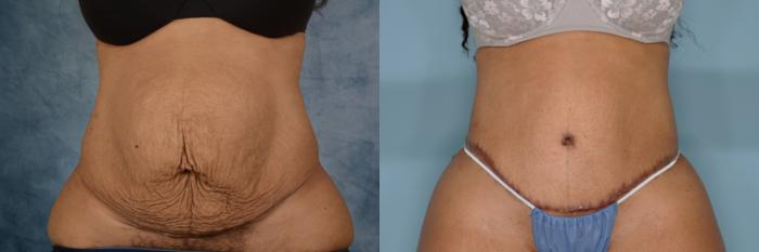 Before & After Extended Tummy Tuck (Abdominoplasty)  Case 703 Front View in Tallahassee, FL