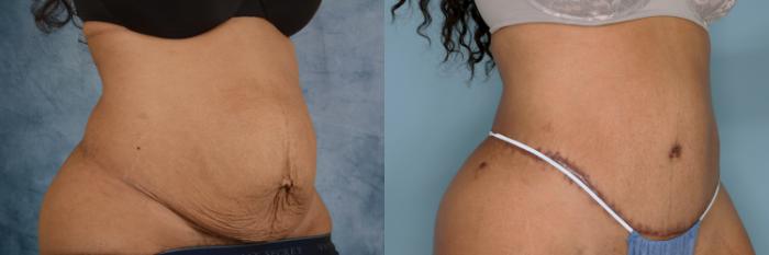 Before & After Extended Tummy Tuck (Abdominoplasty)  Case 703 Right Oblique View in Tallahassee, FL