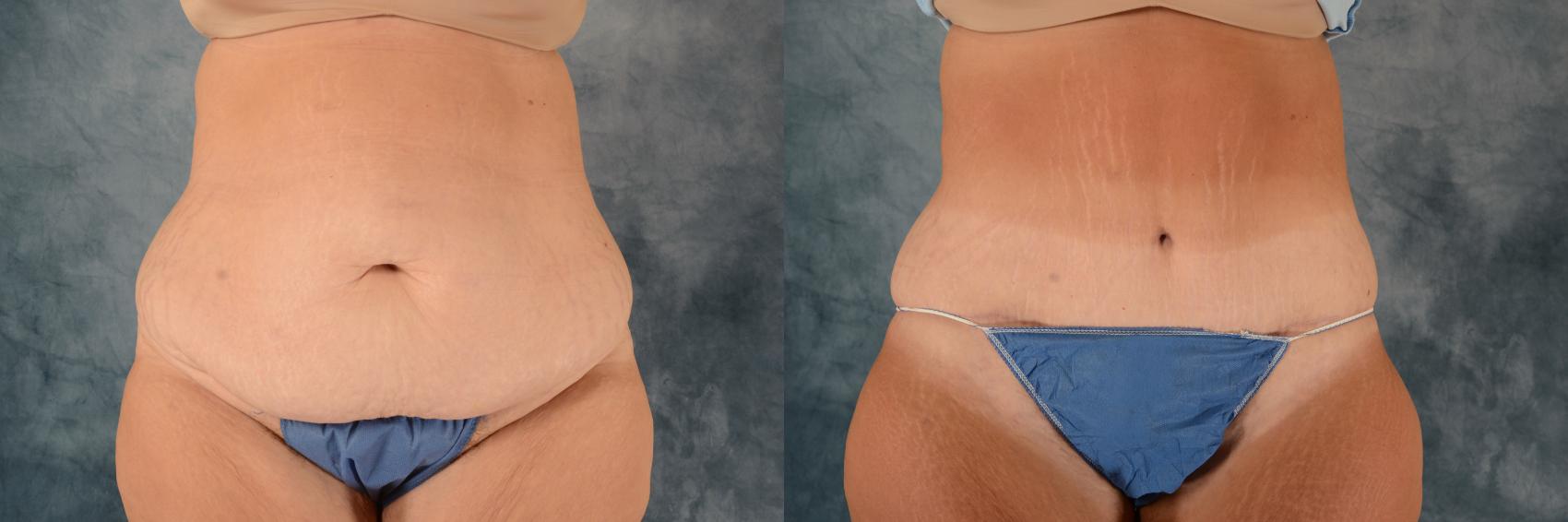 Before & After Extended Tummy Tuck (Abdominoplasty)  Case 738 Front View in Tallahassee, FL