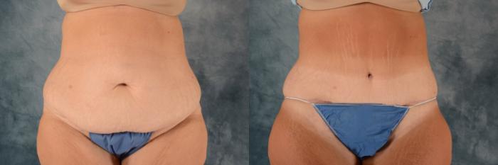 Before & After Extended Tummy Tuck (Abdominoplasty)  Case 738 Front View in Tallahassee, FL