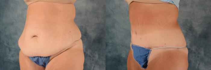 Before & After Extended Tummy Tuck (Abdominoplasty)  Case 738 Left Oblique View in Tallahassee, FL