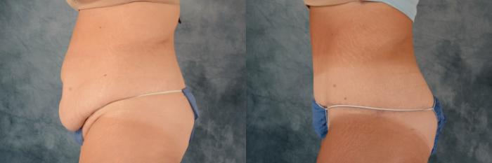 Before & After Extended Tummy Tuck (Abdominoplasty)  Case 738 Left Side View in Tallahassee, FL