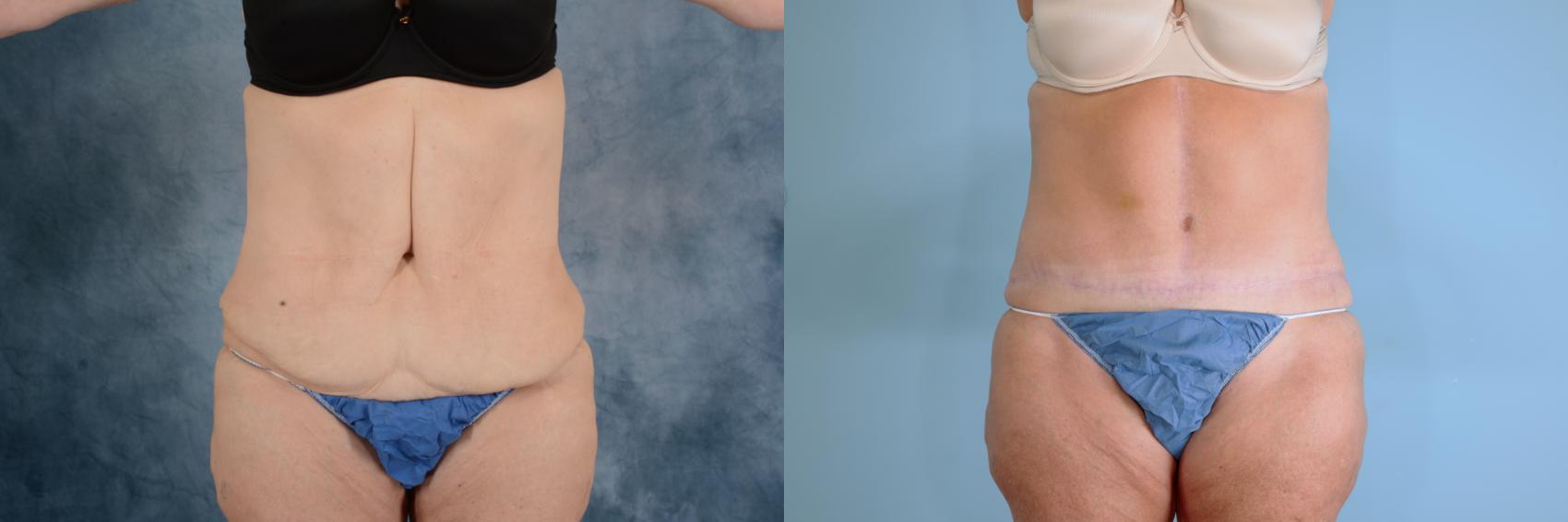 Before & After Extended Tummy Tuck (Abdominoplasty)  Case 740 Front View in Tallahassee, FL
