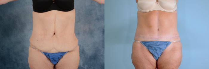 Before & After Extended Tummy Tuck (Abdominoplasty)  Case 740 Front View in Tallahassee, FL
