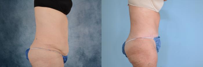 Before & After Extended Tummy Tuck (Abdominoplasty)  Case 740 Right Side View in Tallahassee, FL