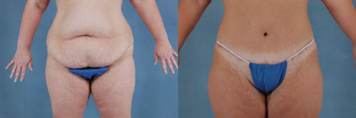 Before & After Abdominoplasty & Breast Augmentation utiliz…