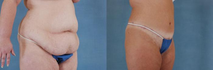 Before & After Extended Tummy Tuck (Abdominoplasty)  Case 96 View #2 View in Tallahassee, FL