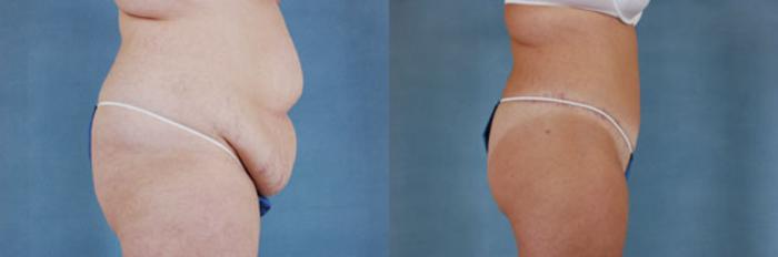Before & After Extended Tummy Tuck (Abdominoplasty)  Case 96 View #3 View in Tallahassee, FL