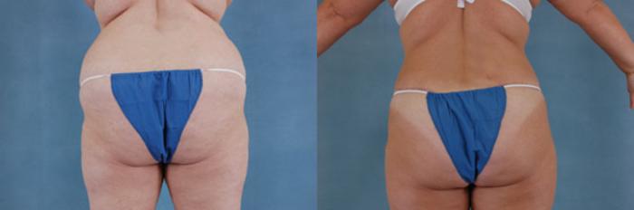 Before & After Extended Tummy Tuck (Abdominoplasty)  Case 96 View #4 View in Tallahassee, FL
