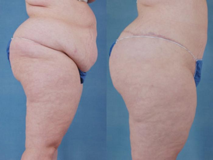Plus Size Tummy Tuck Surgery Before & After Photo Gallery - Patient #61
