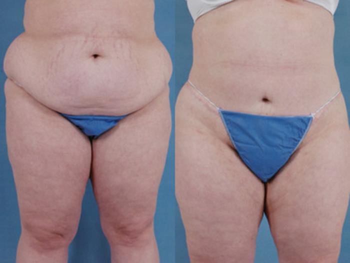 Before & After Extended Tummy Tuck (Abdominoplasty)  Case 97 View #2 View in Tallahassee, FL