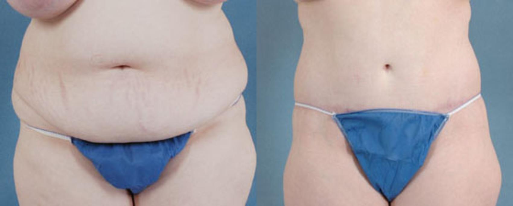 Before & After Extended Tummy Tuck (Abdominoplasty)  Case 98 View #1 View in Tallahassee, FL