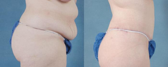 Before & After Extended Tummy Tuck (Abdominoplasty)  Case 98 View #2 View in Tallahassee, FL