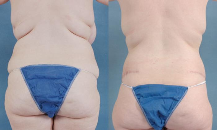 Before & After Extended Tummy Tuck (Abdominoplasty)  Case 98 View #3 View in Tallahassee, FL