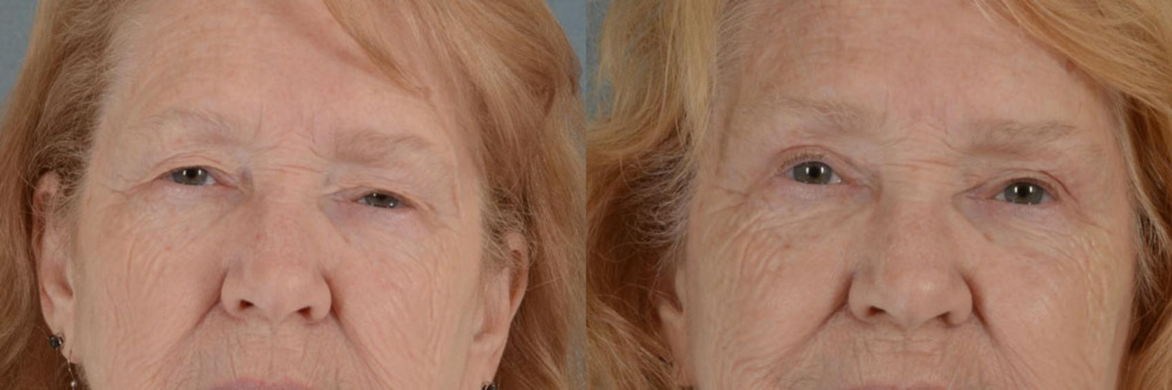 Before & After Eyelid Surgery (Blepharoplasty) Case 12 View #1 View in Tallahassee, FL