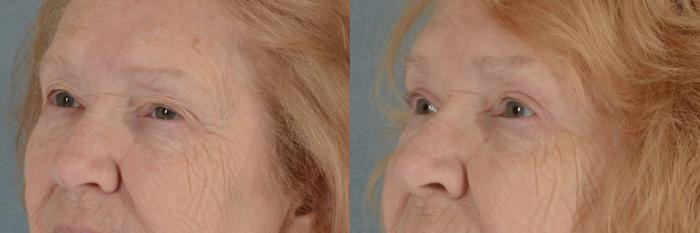 Before & After Eyelid Surgery (Blepharoplasty) Case 12 View #2 View in Tallahassee, FL