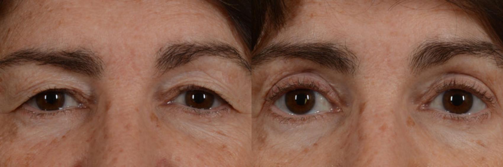 Before & After Eyelid Surgery (Blepharoplasty) Case 13 View #1 View in Tallahassee, FL
