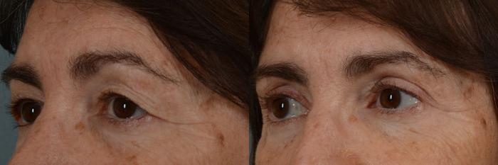 Before & After Eyelid Surgery (Blepharoplasty) Case 13 View #2 View in Tallahassee, FL