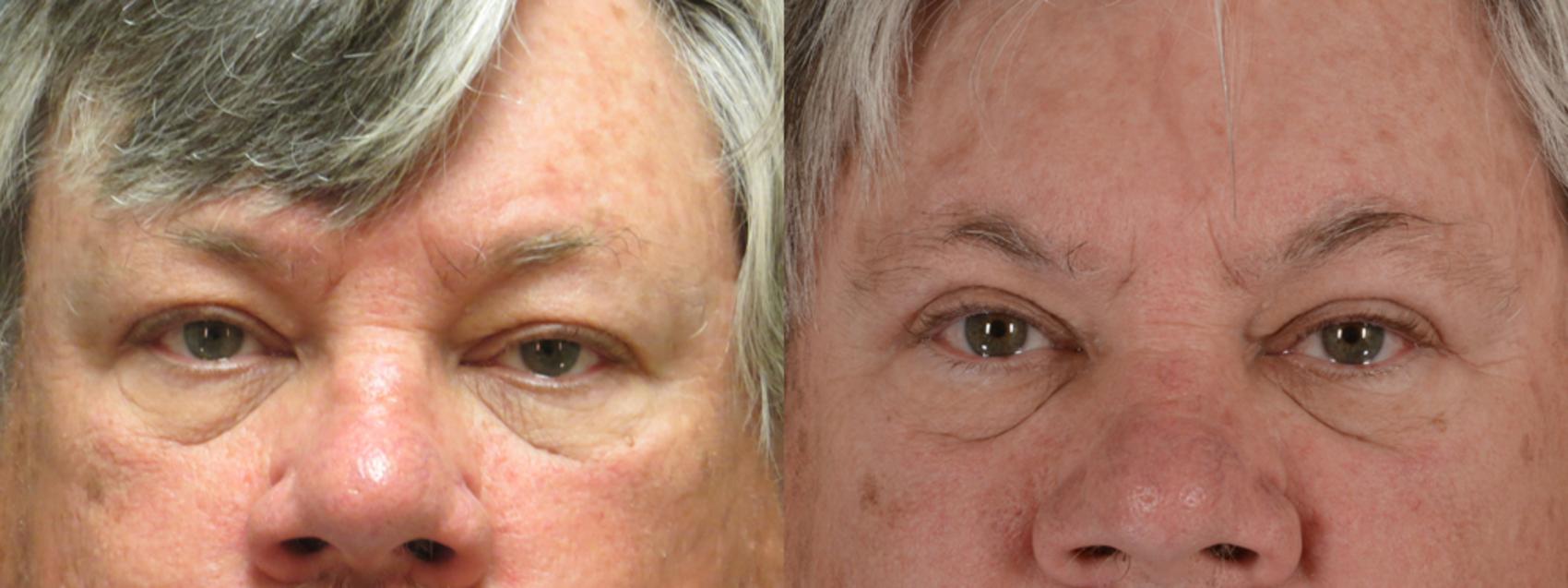 Before & After Eyelid Surgery (Blepharoplasty) Case 14 View #1 View in Tallahassee, FL