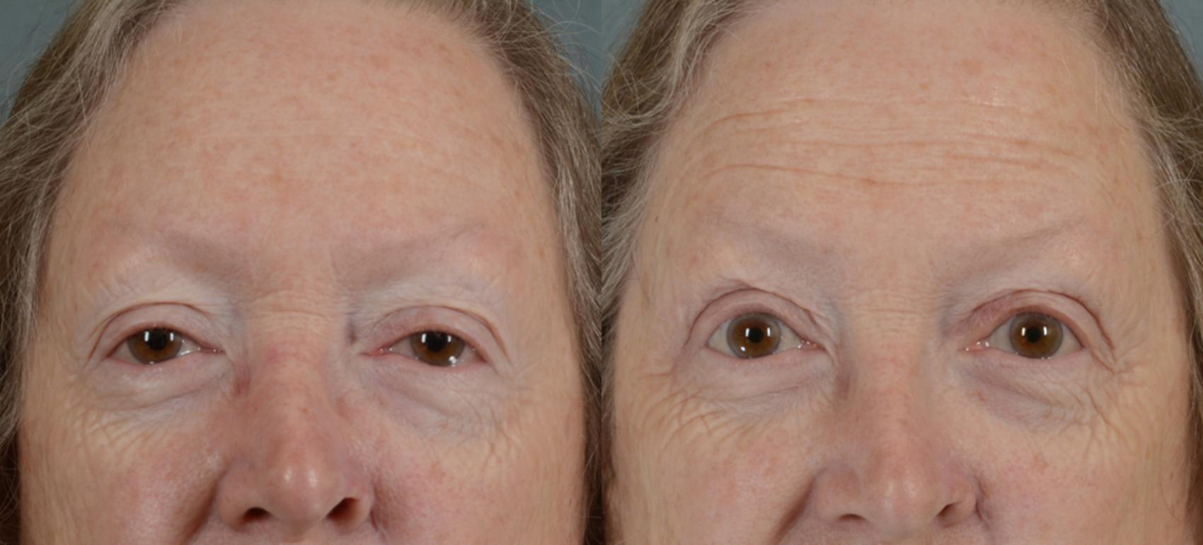 Before & After Eyelid Surgery (Blepharoplasty) Case 15 View #1 View in Tallahassee, FL