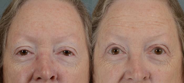 Before & After Eyelid Surgery (Blepharoplasty) Case 15 View #1 View in Tallahassee, FL