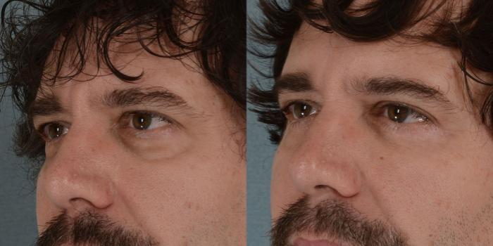 Before & After Eyelid Surgery (Blepharoplasty) Case 16 View #3 View in Tallahassee, FL