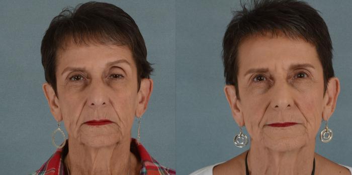 Before & After Eyelid Surgery (Blepharoplasty) Case 17 View #1 View in Tallahassee, FL
