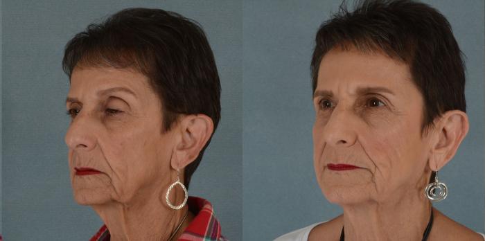 Before & After Eyelid Surgery (Blepharoplasty) Case 17 View #2 View in Tallahassee, FL