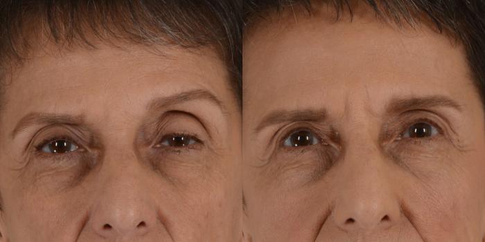 Before & After Eyelid Surgery (Blepharoplasty) Case 17 View #3 View in Tallahassee, FL