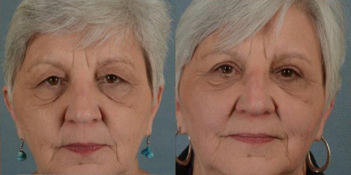 Before & After Eyelid Surgery (Blepharoplasty) Case 18 View #1 View in Tallahassee, FL