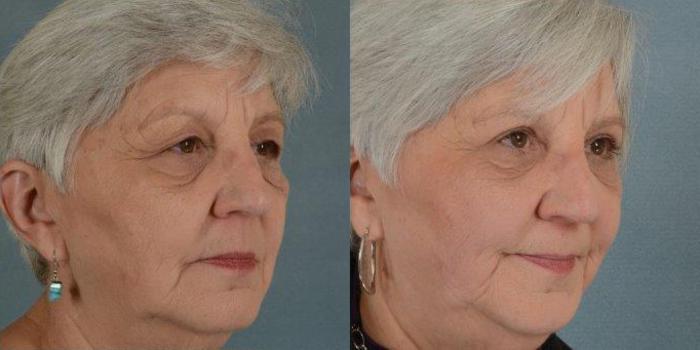 Before & After Eyelid Surgery (Blepharoplasty) Case 18 View #2 View in Tallahassee, FL